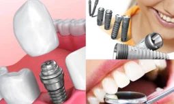 İmplant Tedavisi Nedir ve Neden Tercih Edilir?